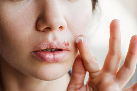 Mujer mostrando cómo prevenir el herpes labial.