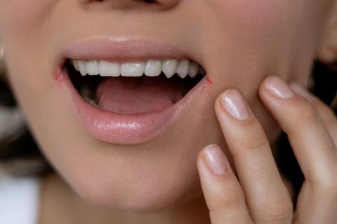 mujer con síntomas visibles de queilitis angular